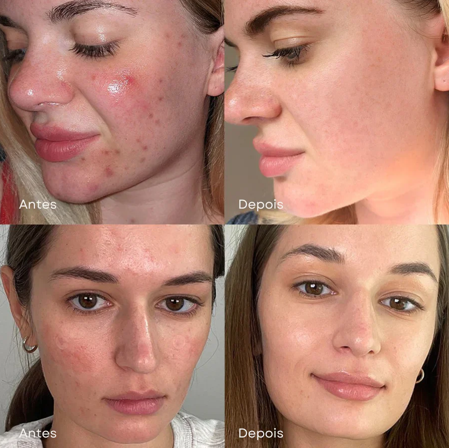 Sérum de Ácido Succínico Vermelho